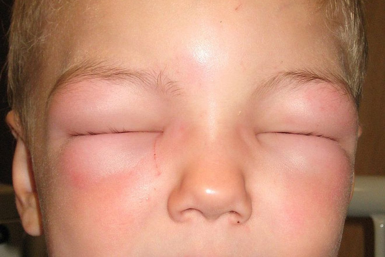 This child suffers from anaphylaxis and cannot open his eyes due to swelling. James Heilman, M.D., Wikimedia Commons.