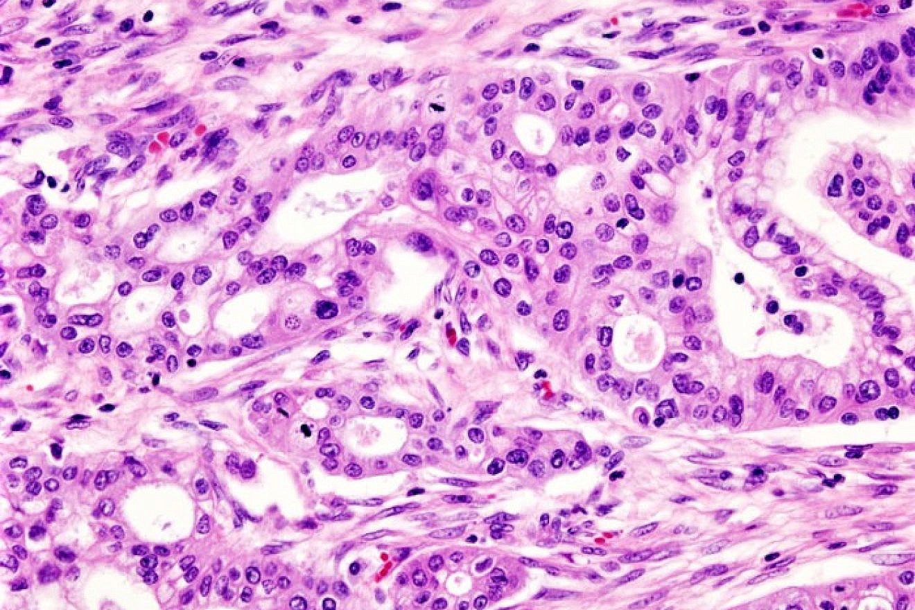 A micrograph of pancreatic ductal adenocarcinoma, the most common type of pancreatic cancer. Credit: Wikimedia Commons.